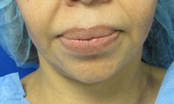 Chin Implant Before & After Patient #8307