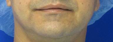 Chin Implant Before & After Patient #8312
