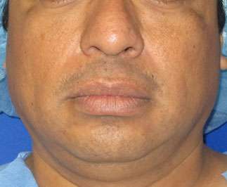 Chin Implant Before & After Patient #8317
