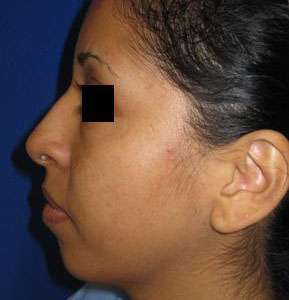 Chin Implant Before & After Patient #8327
