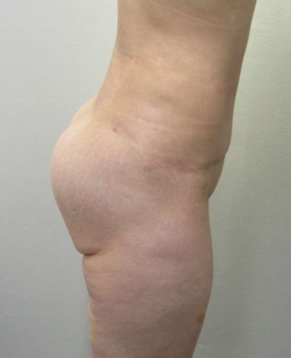 Body Lift Before & After Patient #6009