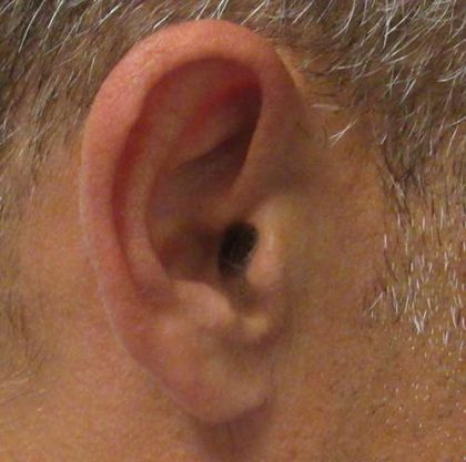 Ear Correction Before & After Patient #8373