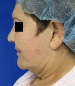 Facelift Before & After Patient #8508