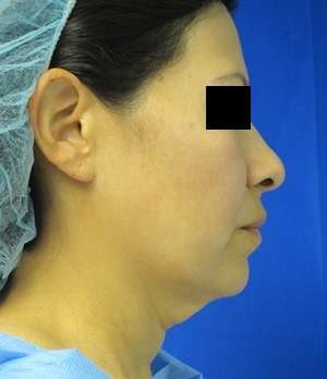 Facelift Before & After Patient #8522