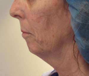 Facelift Before & After Patient #8527