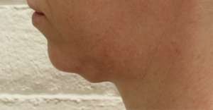 Facelift Before & After Patient #8534
