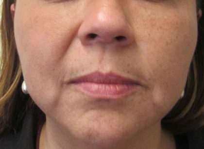 Facetite Before & After Patient #8546