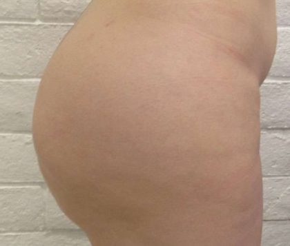 Fat Necrosis and Dead Fat Removal Before & After Patient #8586