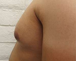 Gynecomastia Before & After Patient #8602