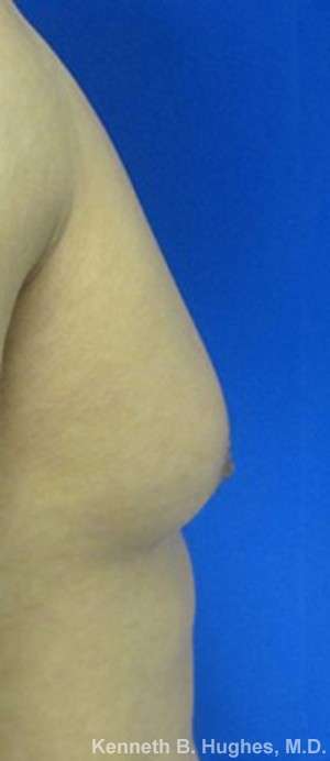 Gynecomastia Before & After Patient #8609