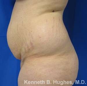 Liposuction Before & After Patient #8689