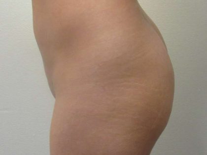Liposuction Before & After Patient #8696