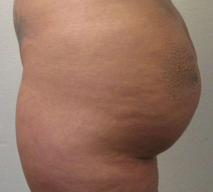 Liposuction Before & After Patient #8774