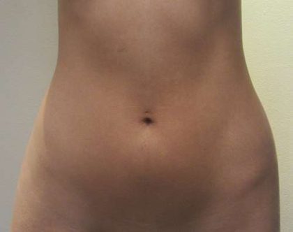 Liposuction Before & After Patient #8802