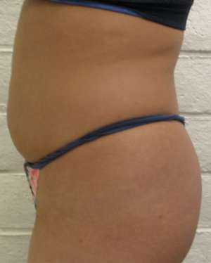 Liposuction Before & After Patient #8837