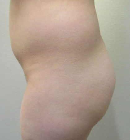 Liposuction Before & After Patient #8844