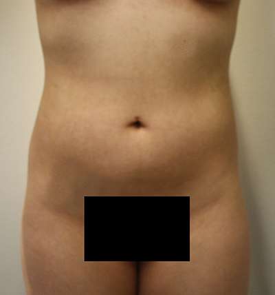 Liposuction Before & After Patient #8871