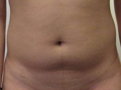 Liposuction Before & After Patient #8888