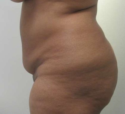 Liposuction Before & After Patient #8896