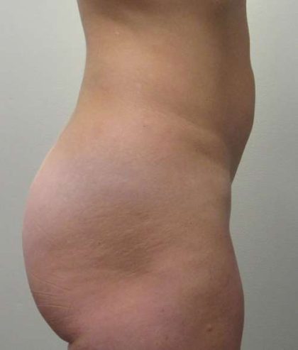 Liposuction Before & After Patient #8903