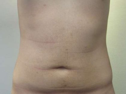 Liposuction Before & After Patient #8908