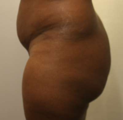 Liposuction Before & After Patient #8925