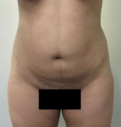 Liposuction Before & After Patient #8930