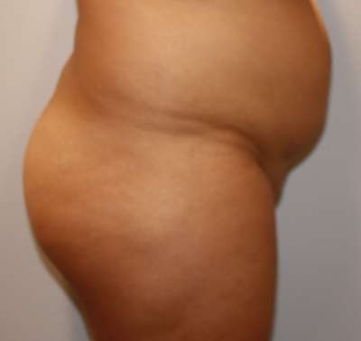 Liposuction Before & After Patient #8935