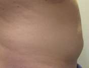 Bodytite Before & After Patient #6060