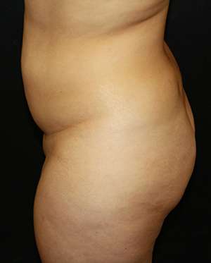 Liposuction Before & After Patient #8948