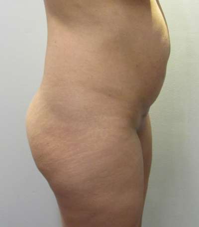 Liposuction Before & After Patient #8966