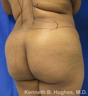 Liposuction Before & After Patient #9017