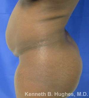 Liposuction Before & After Patient #9076