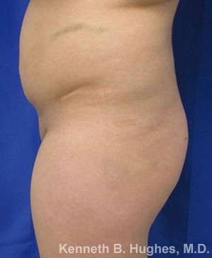 Liposuction Before & After Patient #9087