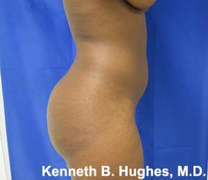 Liposuction Before & After Patient #9102
