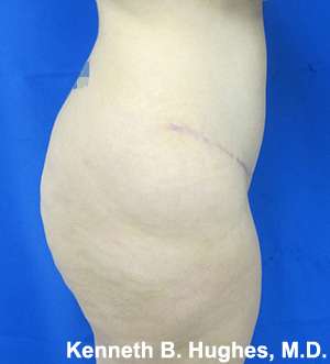 Liposuction Before & After Patient #9107