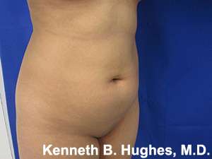 Liposuction Before & After Patient #9115