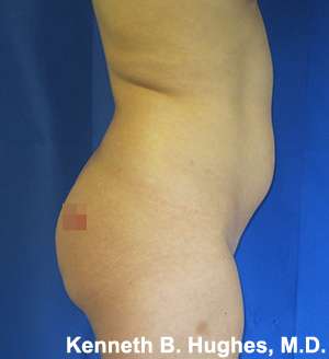 Liposuction Before & After Patient #9120