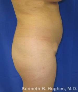 Liposuction Before & After Patient #9136