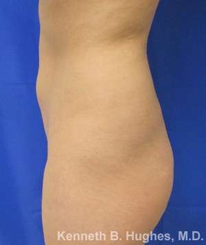 Liposuction Before & After Patient #9141