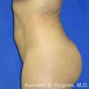 Liposuction Before & After Patient #9167