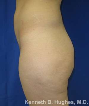 Liposuction Before & After Patient #9172
