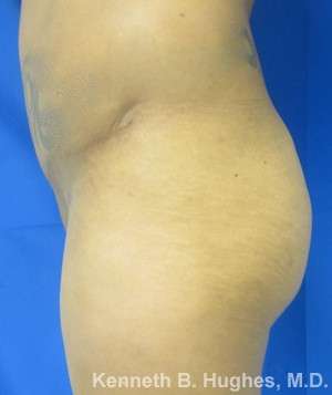 Liposuction Before & After Patient #9183