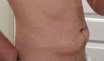 Bodytite Before & After Patient #6111