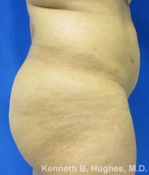 Liposuction Before & After Patient #9240