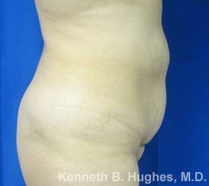 Liposuction Before & After Patient #9255