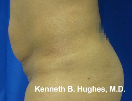 Liposuction Before & After Patient #9284