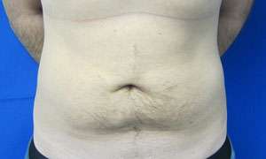 Liposuction Before & After Patient #9310