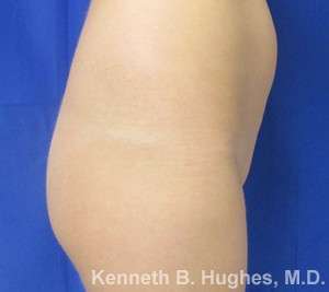 Liposuction Before & After Patient #9323