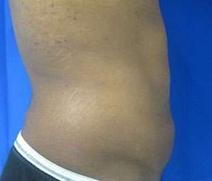 Liposuction Before & After Patient #9414
